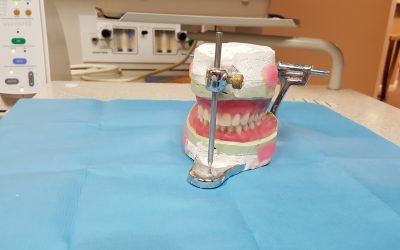 Repairs – What to do if your Denture Crack or Breaks