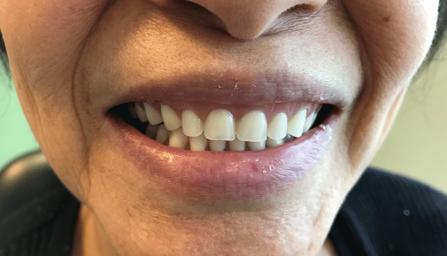 Implant-Retained Dentures Airdrie 