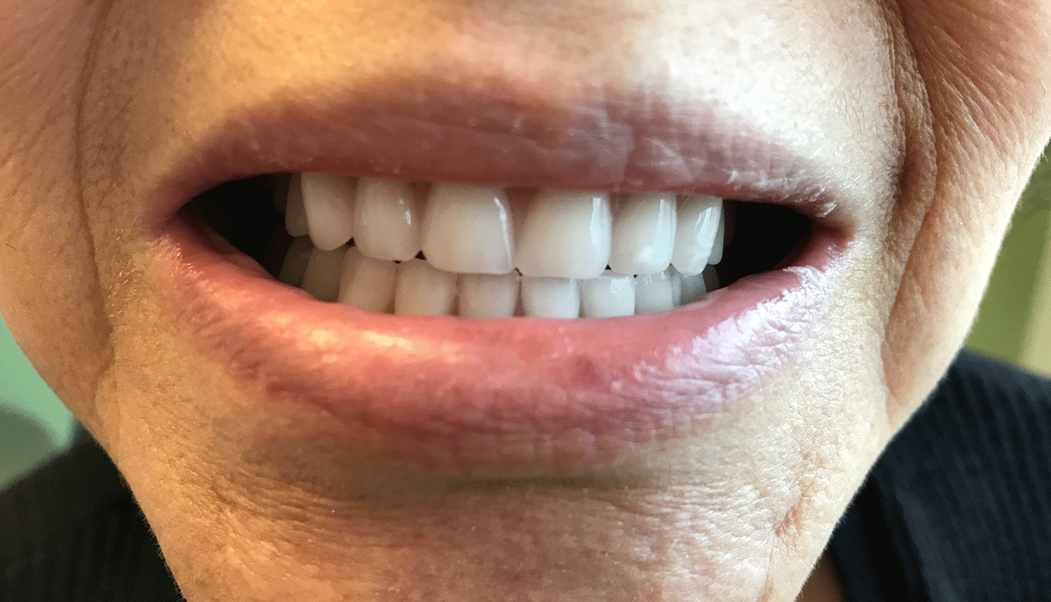 Partial Dentures Airdrie