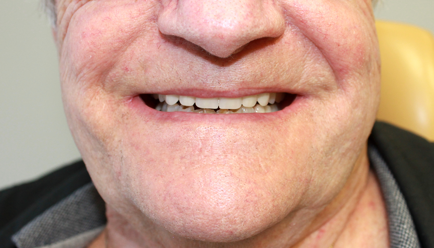 Standard Dentures Airdrie