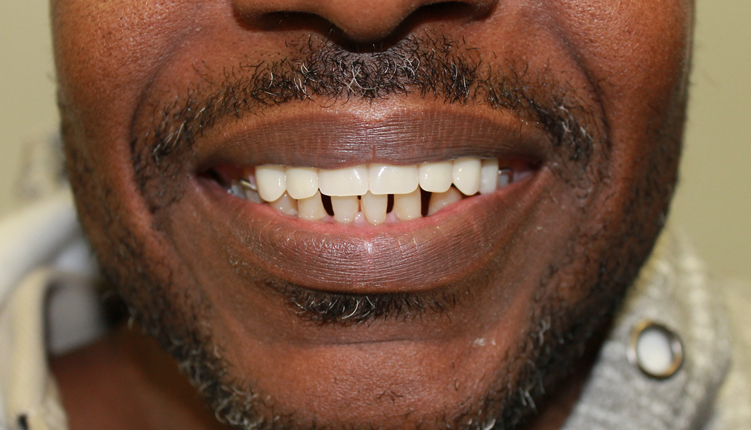 Dentures Costs Airdrie