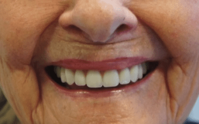 Denture Adhesives with Temporary Liners – Things You Should Know