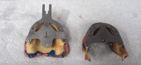 How Dentures are Made – A Step by Step Visual - Woodside Denture Centre