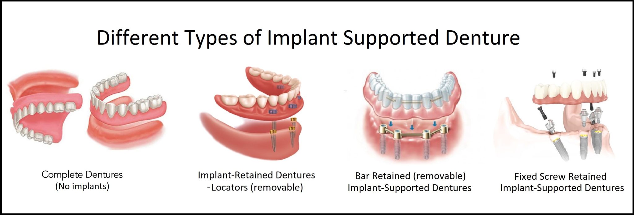 dental-implants-in-airdrie-alberta-woodside-denture-centre