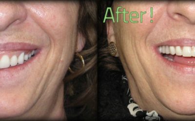 How Poor Dentures affect your Speech