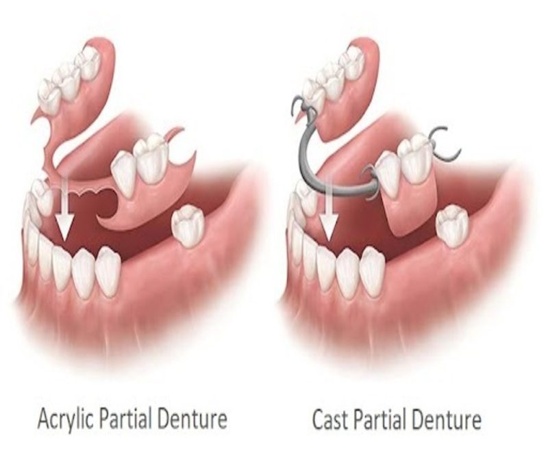 Partial Dentures vs. Complete Dentures