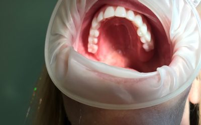 How Many Implants Are Needed for Implant Dentures?