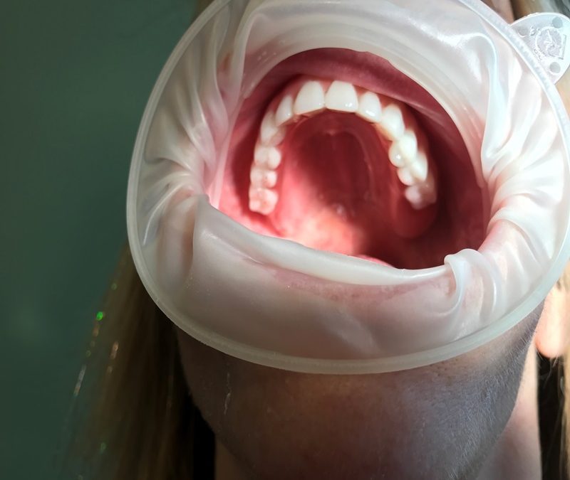 Dentures in Alberta