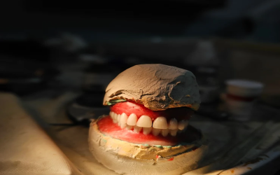 Life with Dentures in Alberta: Why Dentures Feel Loose Over Time